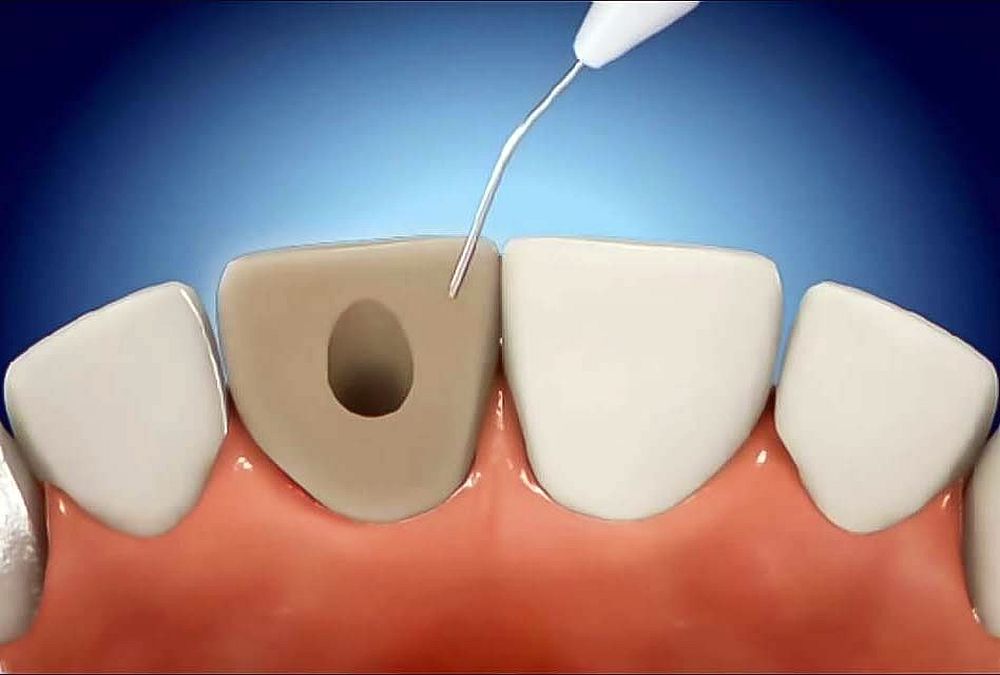 Внутриканальное отбеливание зуба
