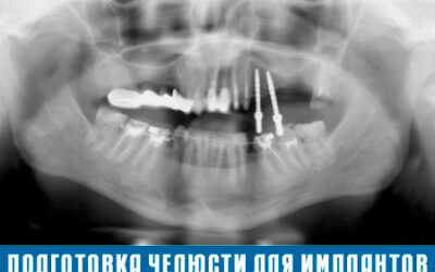Имплантация зубов — передовой метод