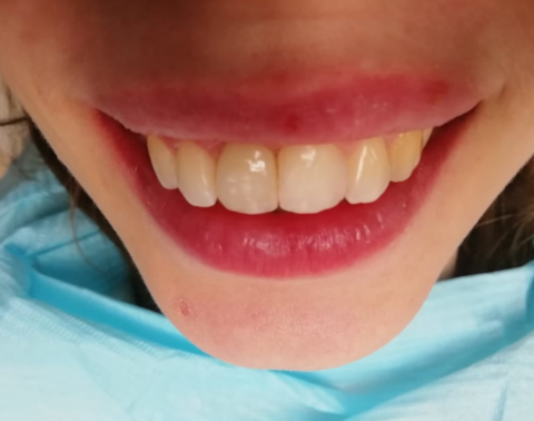 Восстановление зуба. Пациентка 26 лет.
