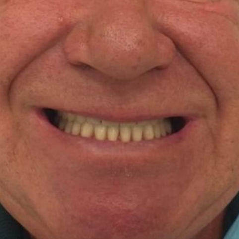 Пациент, 64 года. Полное отсутствие зубов.